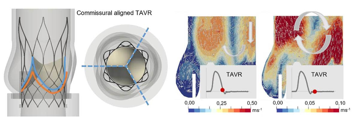 Thrombosis risk assesment using CFD simulation from PIV data